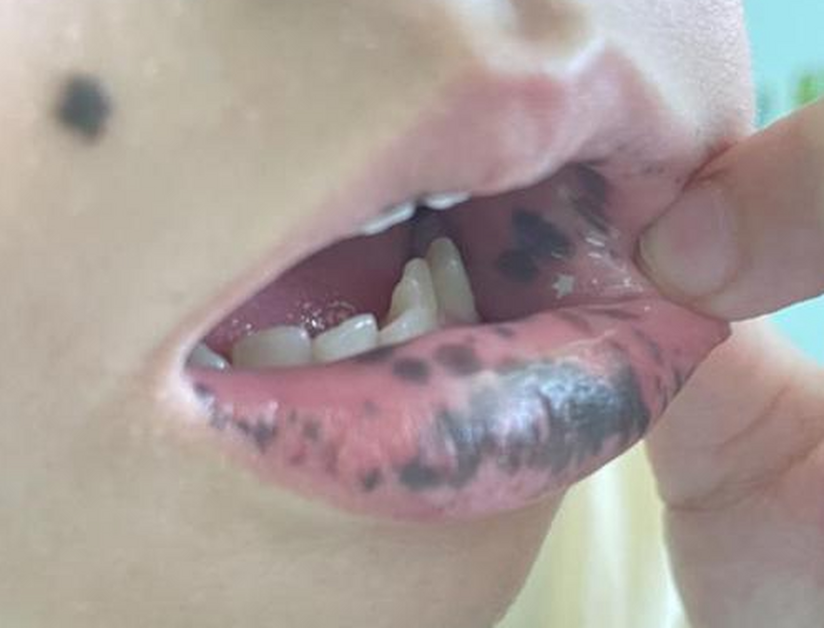 2岁的小男孩,总是不好好吃饭,到医院就诊,医生发现孩子嘴唇上有一块"