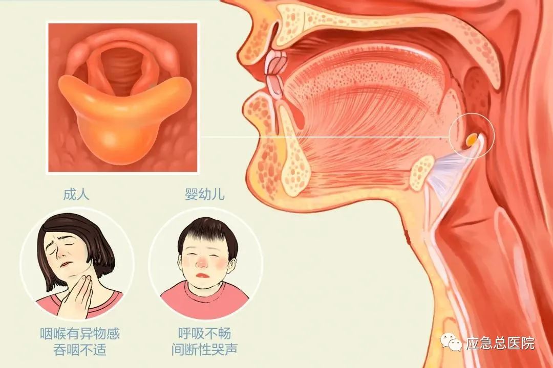 会厌囊肿手术多少钱图片