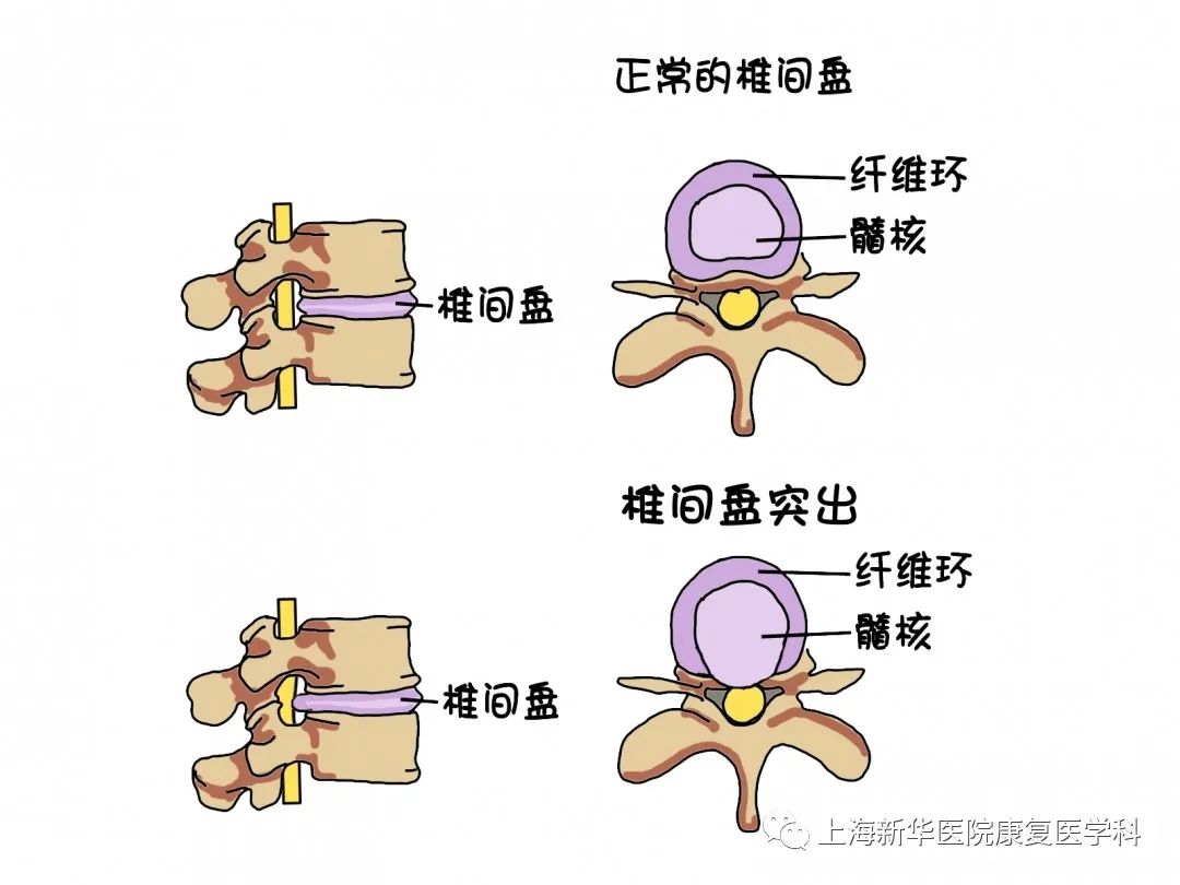 腰椎间盘突出症的康复治疗