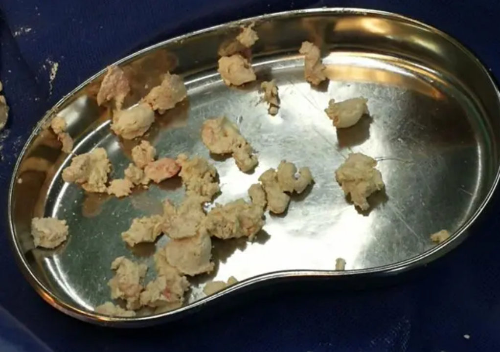 一点君科普|自己把痛风石"挤出来"会发生什么?后果不敢想象!