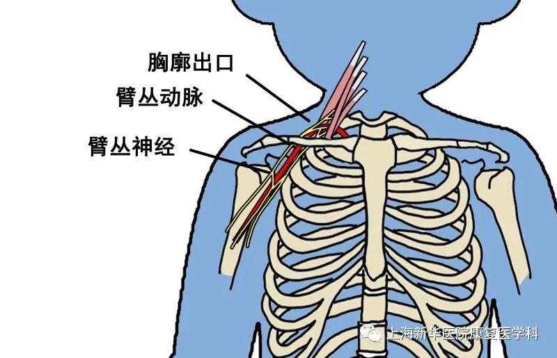 肩臂痛,上肢麻, 你是否有胸廓出口综合征?