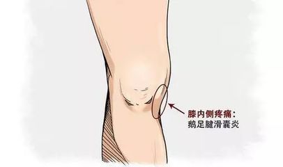 活动时膝关节咔咔响是怎么回事?那是身体有一股气体在"作祟"!