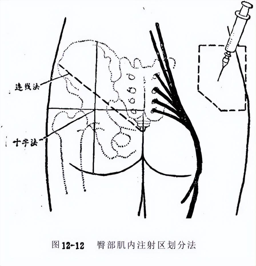 梨状肌封闭进针点图图片