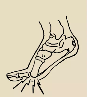 马文足科曹海锟:跖骨痛引发拇外翻怎么治疗?