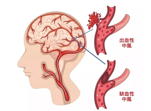 血压高到多少才会发生脑出血?医生给出参考数值,建议心里有数