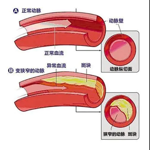 科治好:从生活方式开始,远离心脑血管疾病