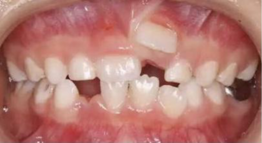 它们占据了正常牙的位置,致使这些正常的牙齿出现错位或萌出障碍