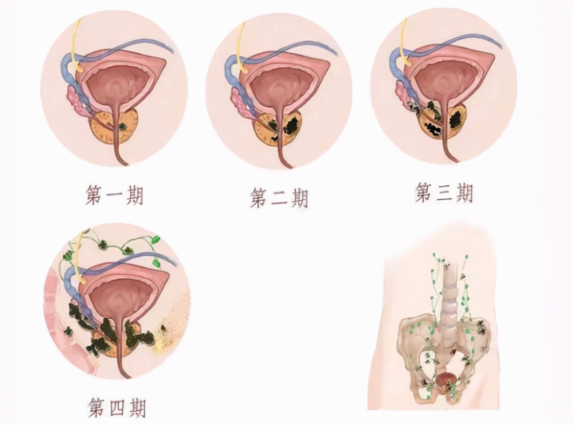 "前列腺癌"发现即晚期?是真的吗?2大症状应尽早发现