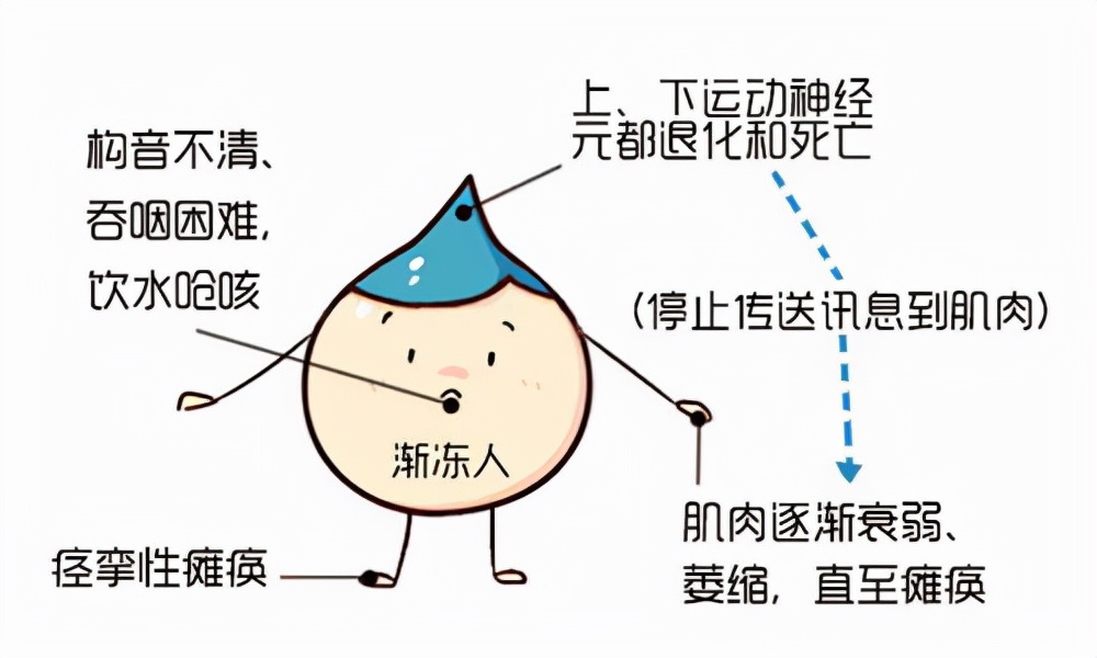 als,是运动神经元病最常见的一种类型,一般中老年发病率比较高