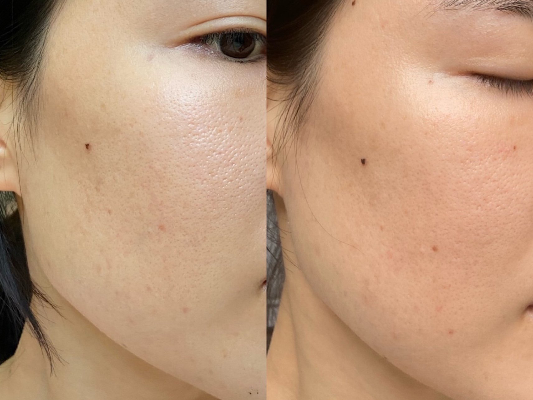 为何会毛孔粗大,毛孔粗大怎么办怎么收缩毛孔?