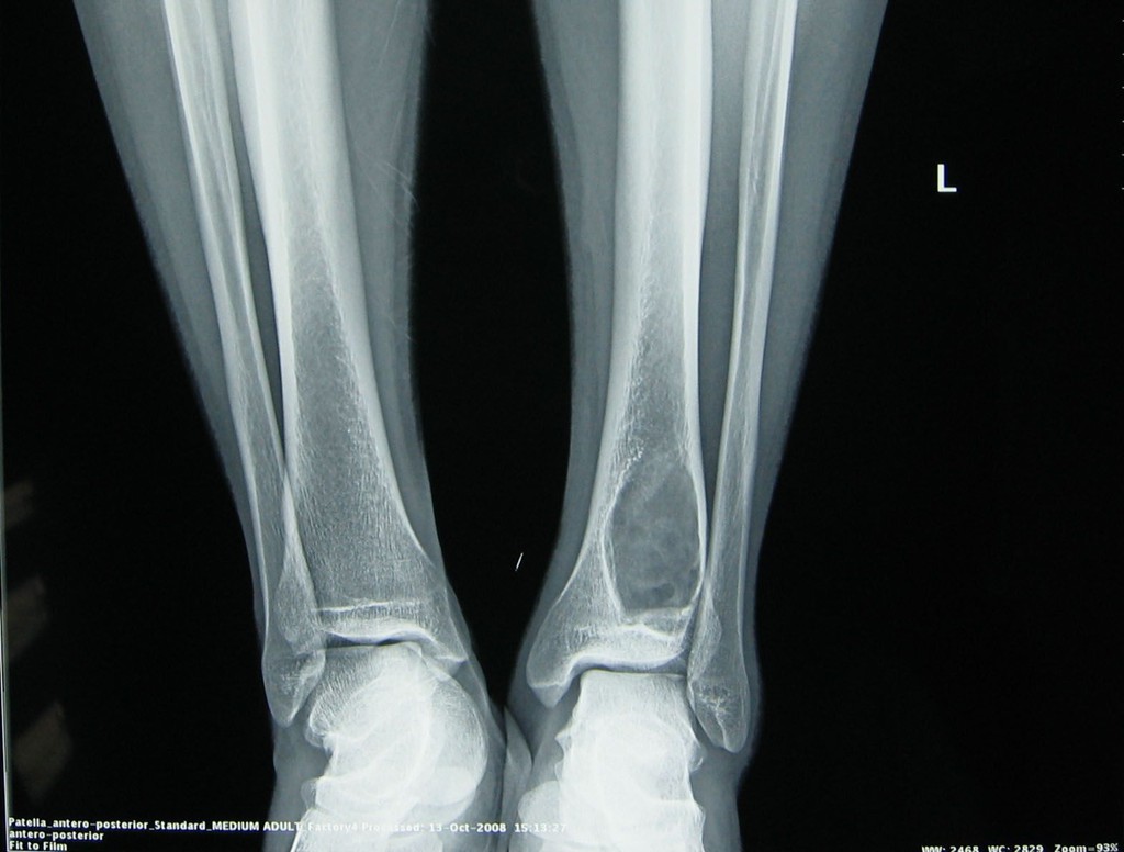 骨样骨瘤,患者的并发症有持续性剧痛,夜间的时候,症状最明显