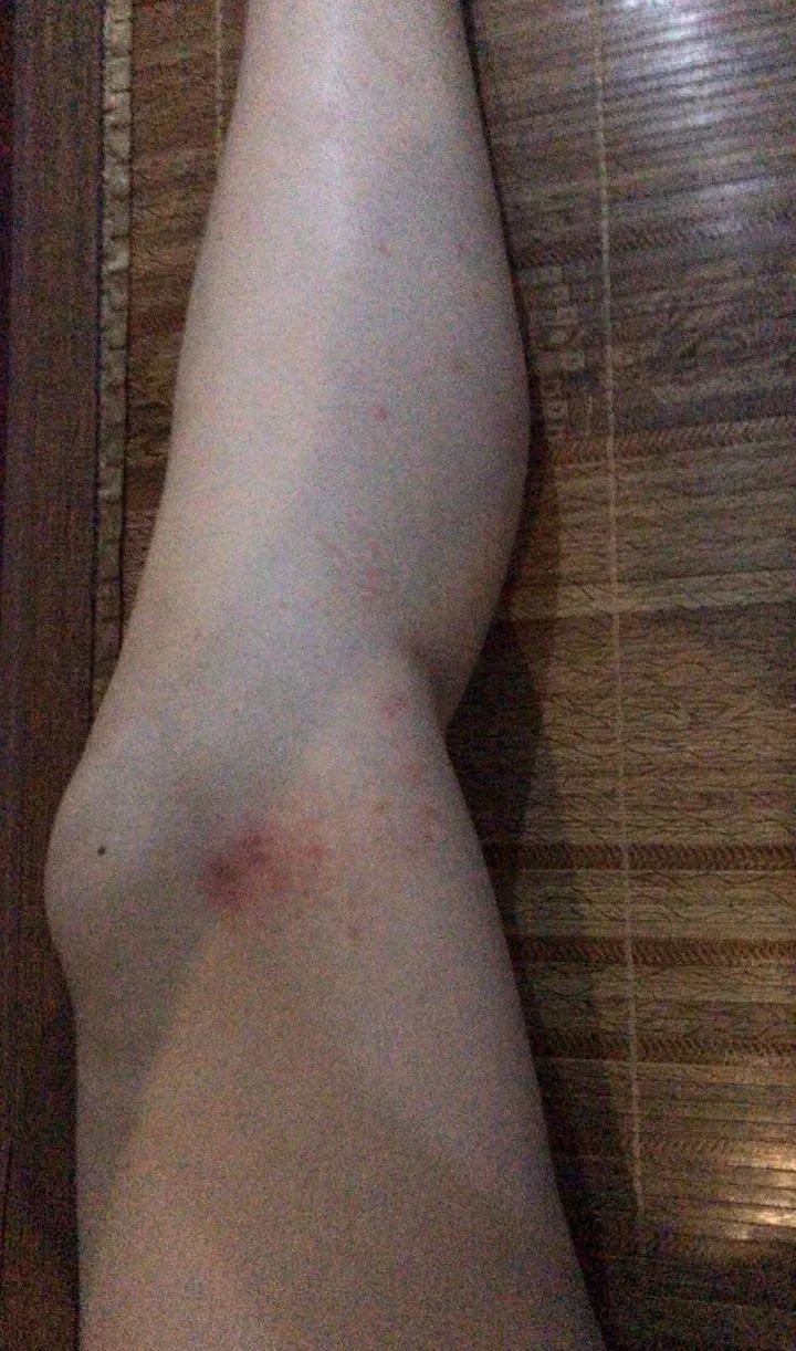 热点|痒！多名游客到东钱湖水上乐园游玩后皮肤过敏，“肇事者”找到了