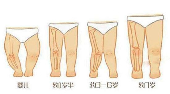 儿童腿型发育标准图片图片