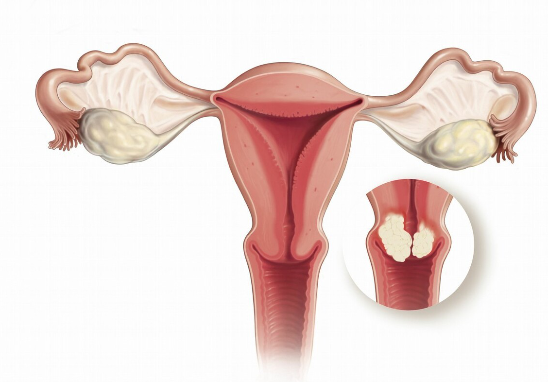 21岁女大学生查出宫颈病变,提醒:上厕所有3情况,趁早去查hpv