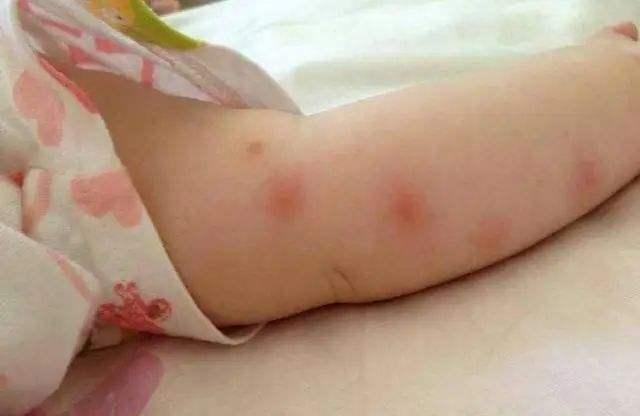 螨虫会造成哪些皮肤问题?