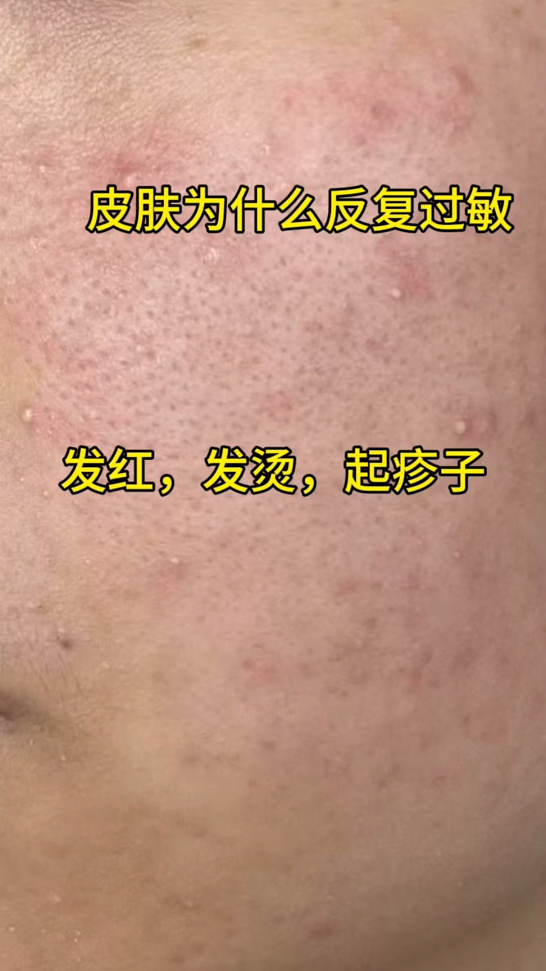 宁愿每天吃氯雷他定也不鼻炎为什么在线