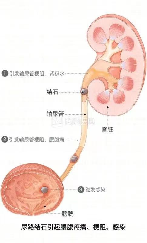 输尿管痉挛图片