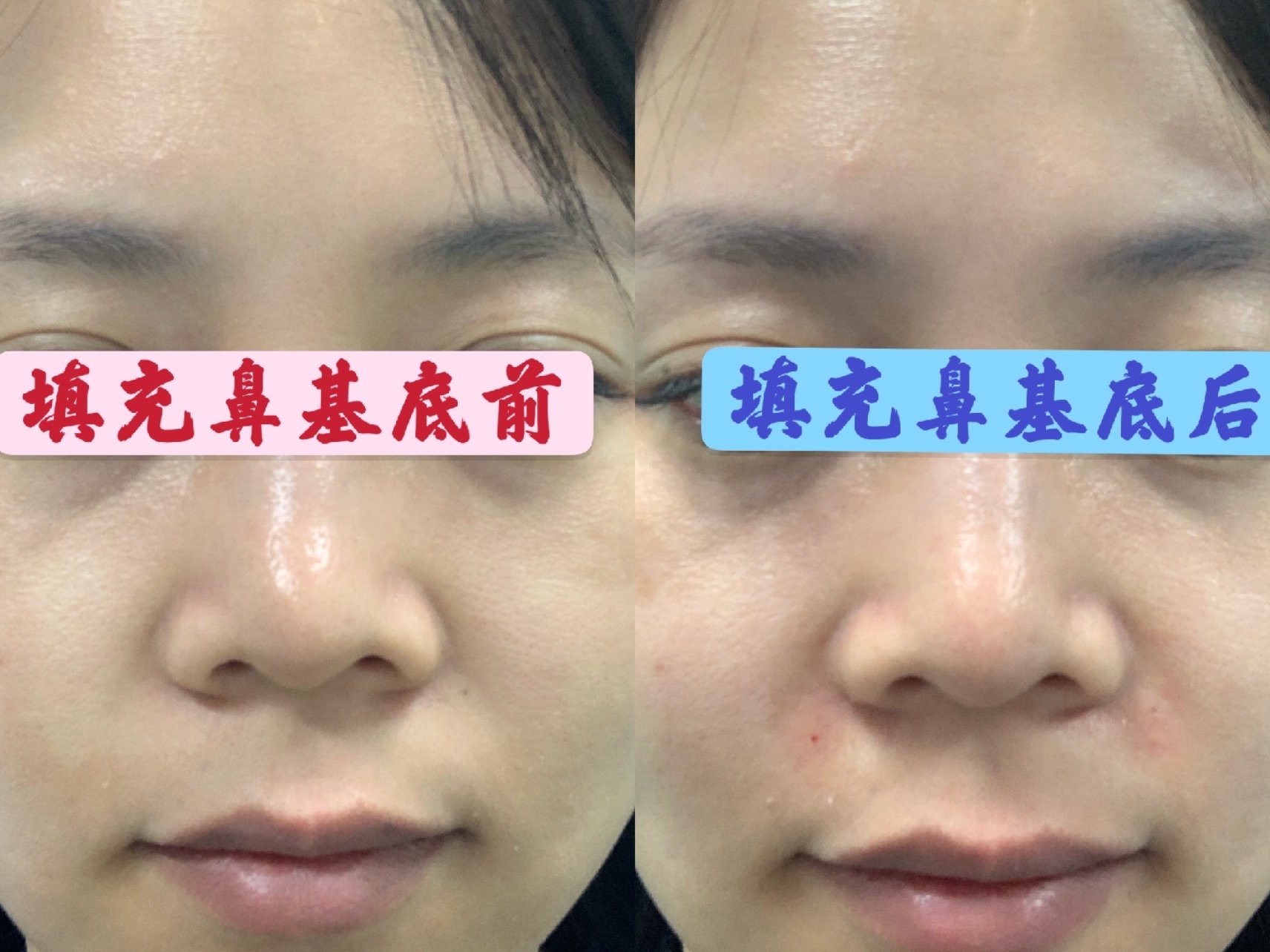 想面部填充,那么选择哪种填充材料比较好呢?