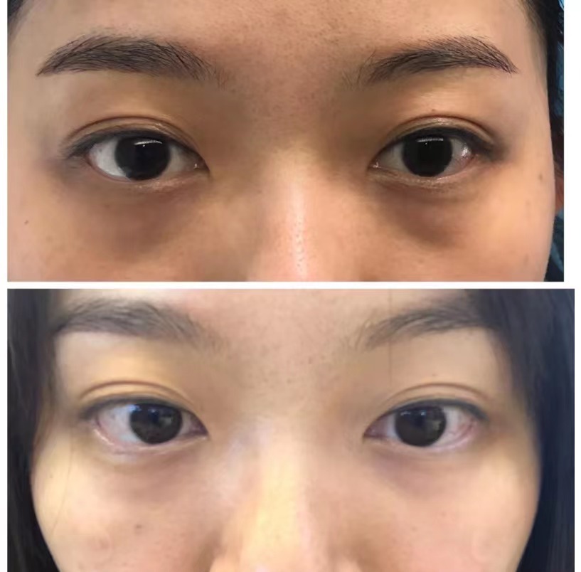 不同眼周问题,该怎么选择治疗方法?还要注意哪些事项?