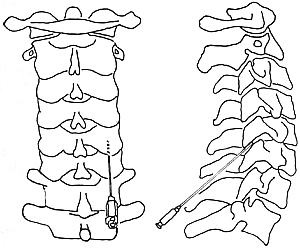 颈椎小关节创伤性退变性关节炎,有损伤性关节炎反应,与创伤有关