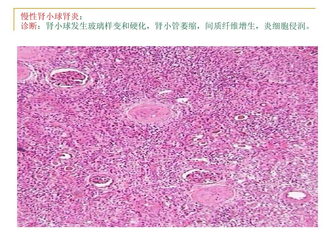 正常肾小球切片图片