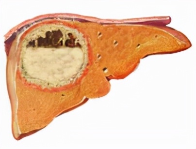 阿米巴肝脓肿脓液图片