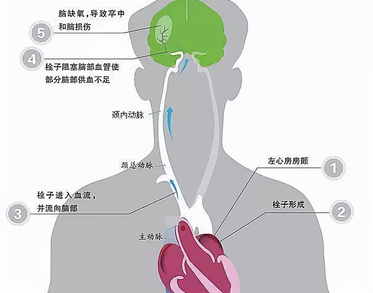 脑栓塞示意图图片