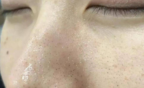 鼻子上挤出来的白色条状物,到底是螨虫还是粉刺?很多人不知情