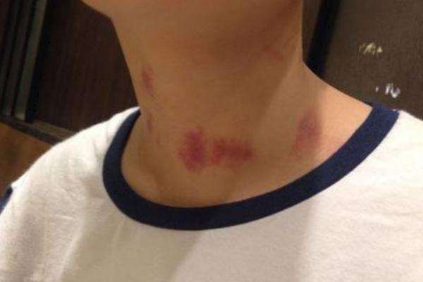 怎么去掉草莓吻痕