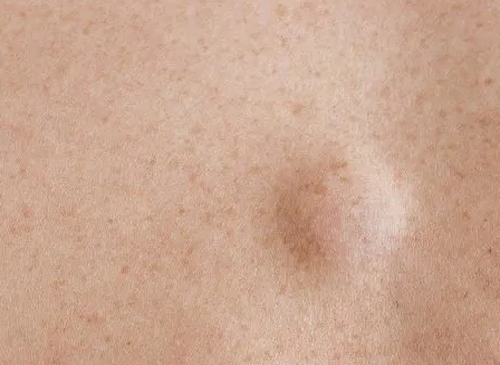 我奶奶背上长了个疙瘩,检查后医生说是粉瘤,切除就行,可术后却说,需要