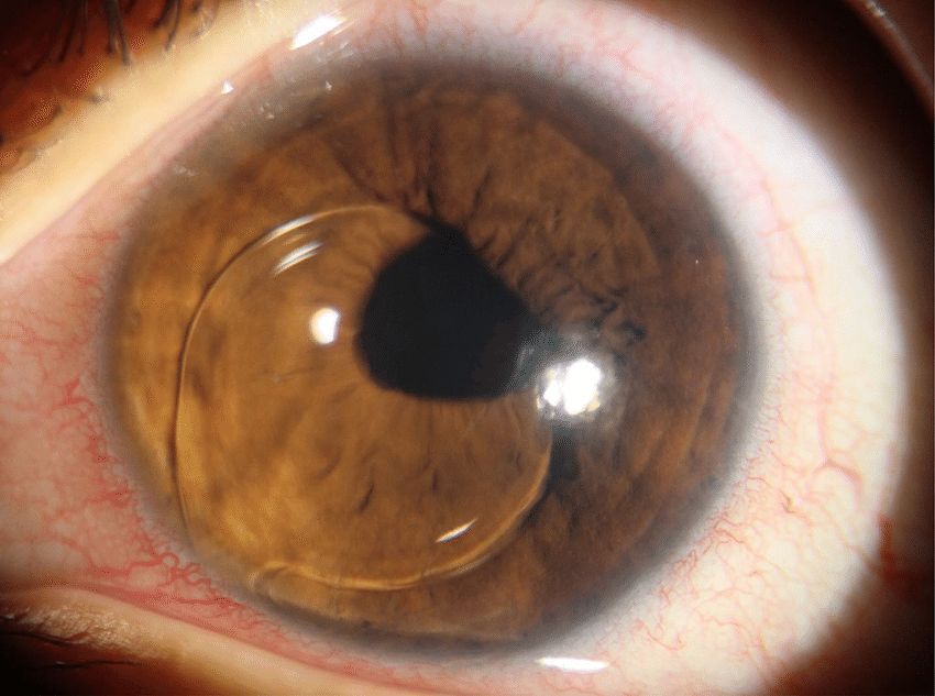 还给眼睛做保健?别乱按,68岁阿姨按出青光眼,这些人风险较高