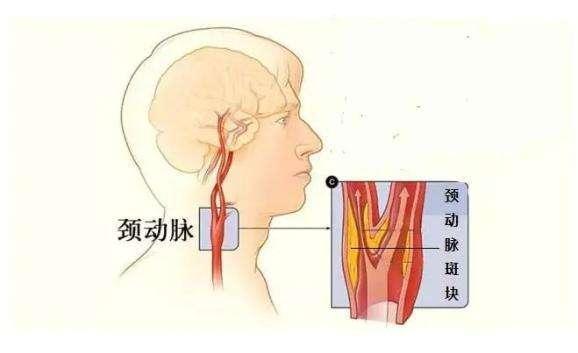 颈动脉堵塞后