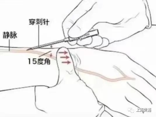 输液完手背上有乌青块是怎么回事?教您破解方法