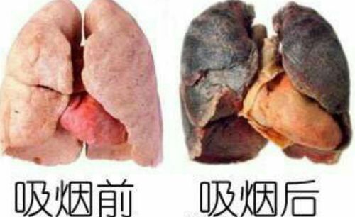 烟雾病对比图片