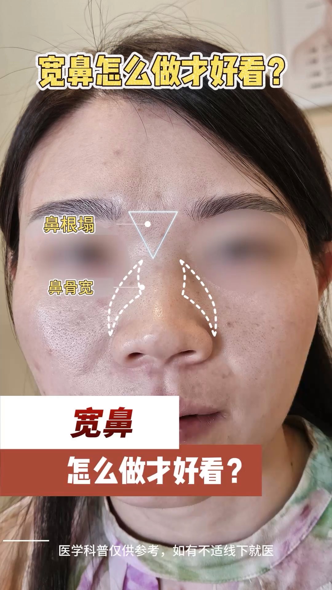 宽鼻怎么做才好看