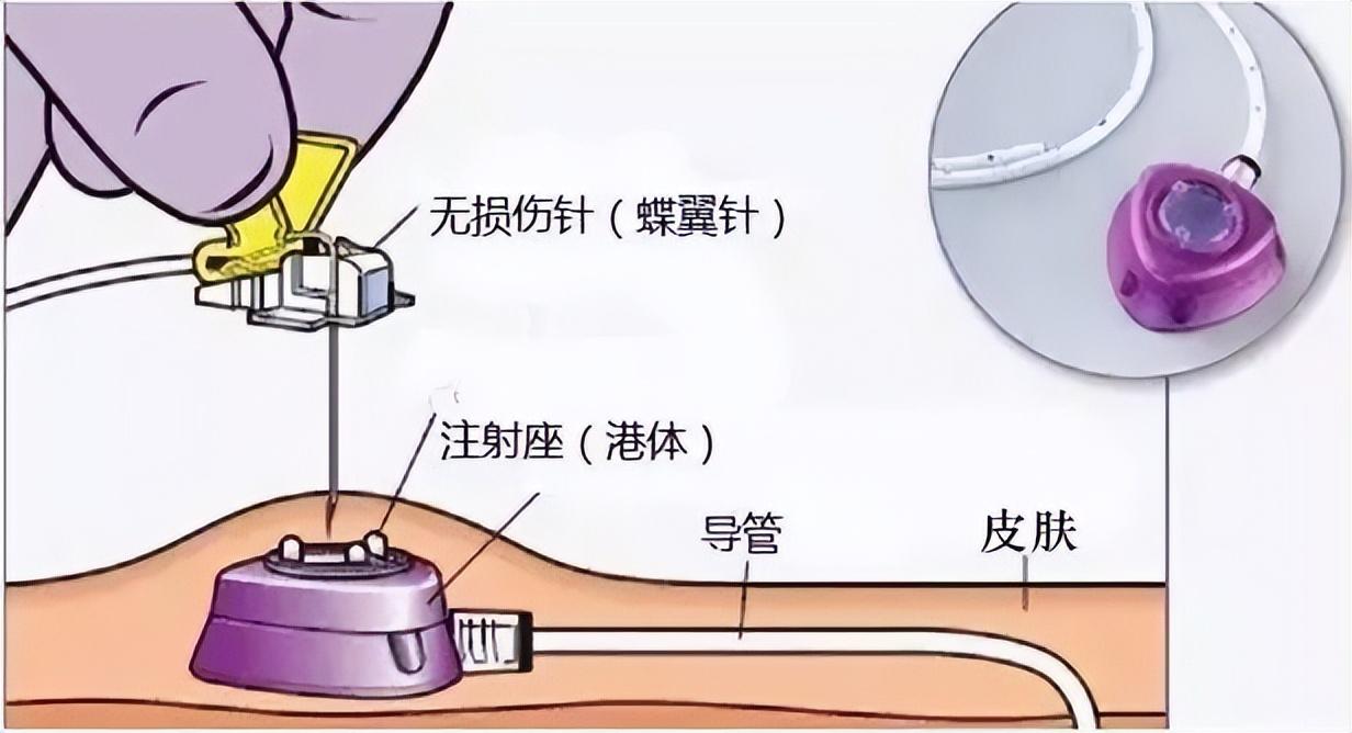 输液港装置图片图片