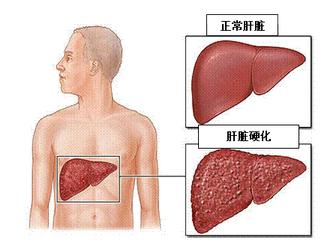 肝癌为何初期不易被发觉?5个原因