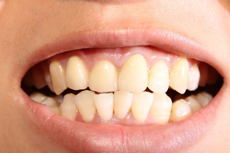 世卫组织曾在2001年提出对中老年人牙齿保健提出目标——"8020",即