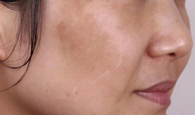 为何女性容易长斑?常见面部祛斑的医美项目有哪些?