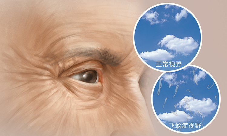 飞蚊症,是指眼前出现飘动的小黑影,可伴有闪光感的一种异常现象