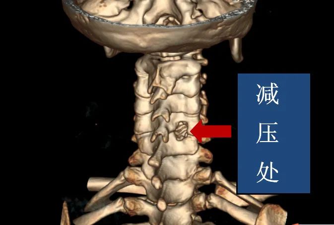 颈椎病后开门手术图解图片