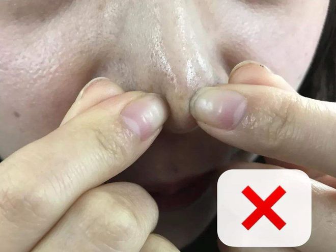 粉刺是常见的皮肤问题,为什么总长粉刺?该怎么做才能去除它们?