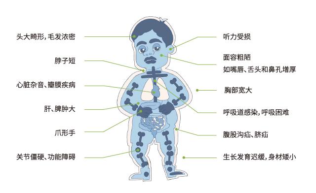 粘多糖患儿早期症状图片