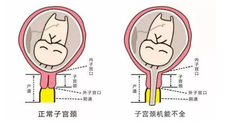 反复自然流产怎么回事?北京家恩德仁告诉你可能是宫颈机能不全