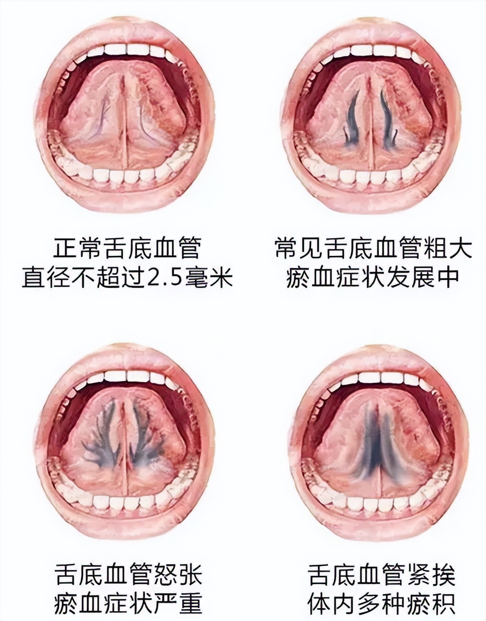  舌頭上地圖狀斑片是怎么回事_舌頭上有地圖