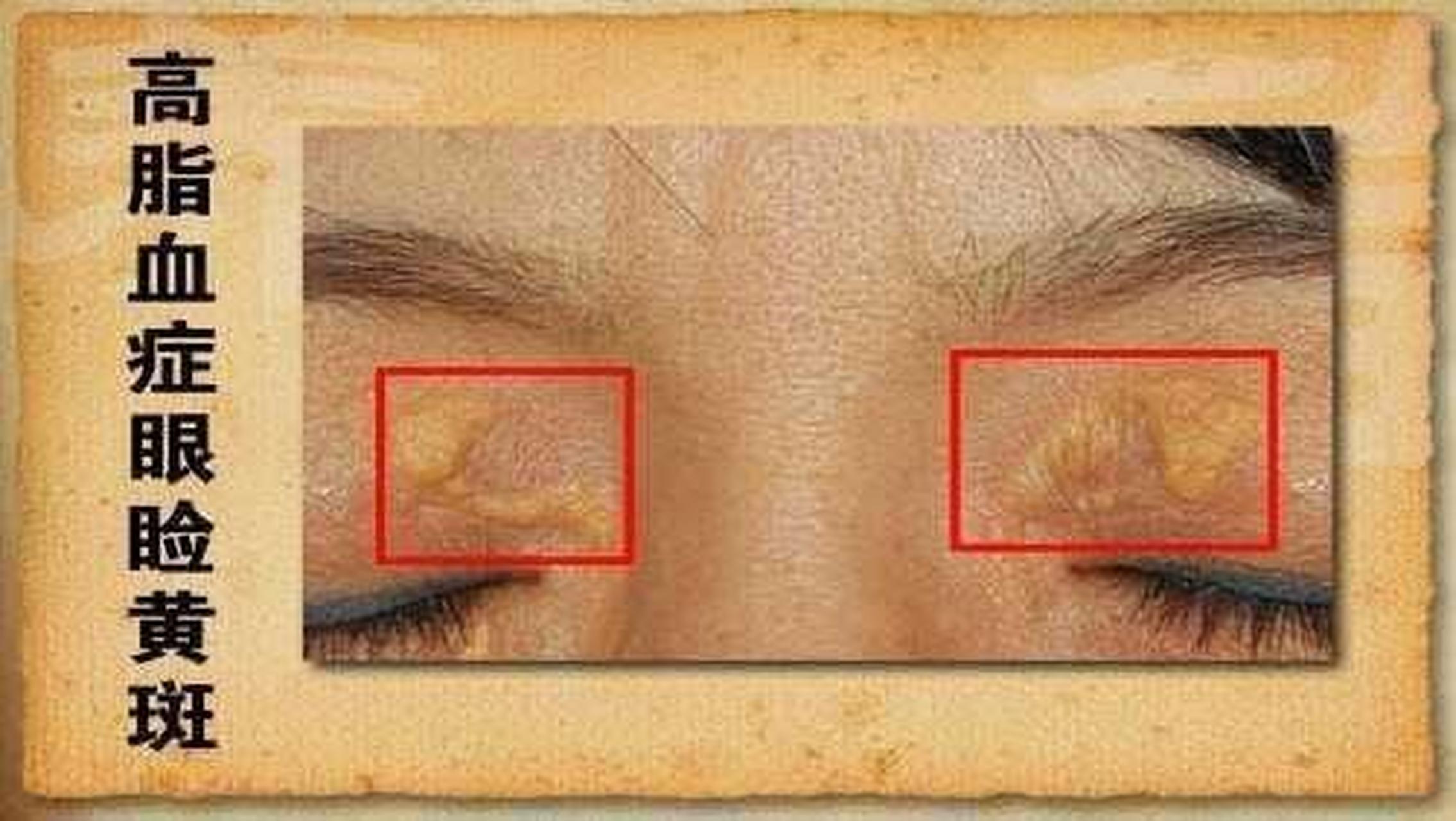 3降至1.5,医生:降血脂3种食物或可多吃