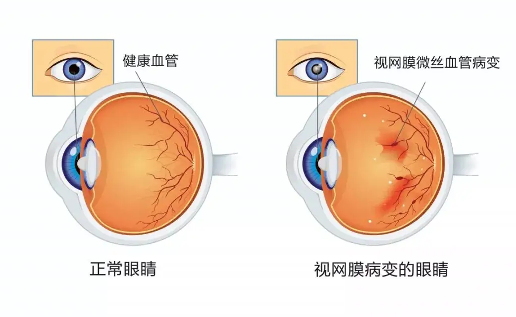 消渴目病——糖尿病性视网膜病变