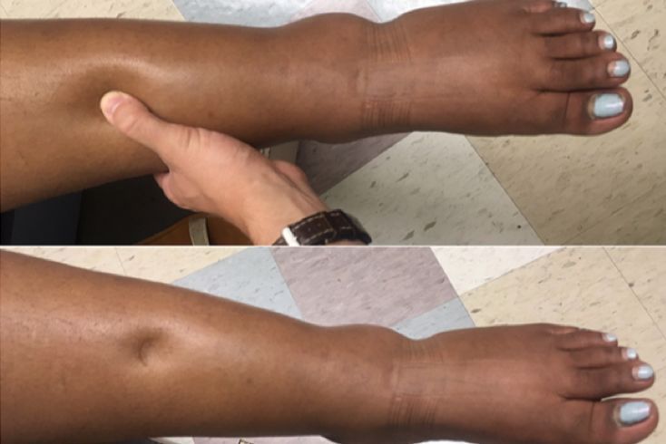 硬皮病详细讲解!