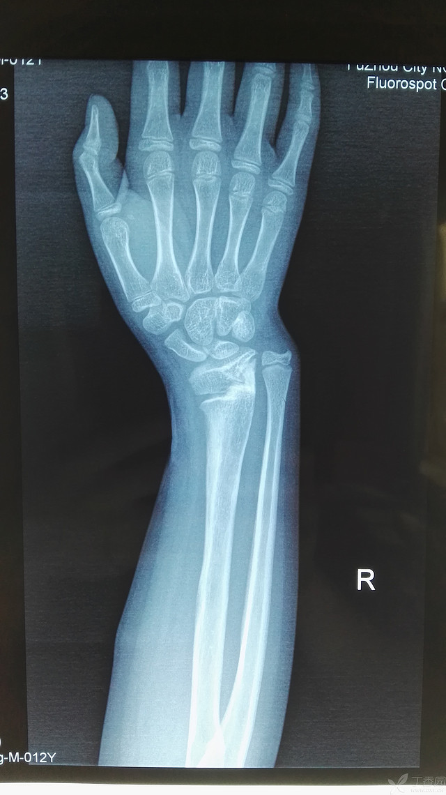 马德隆畸形,经石膏固定愈后佳