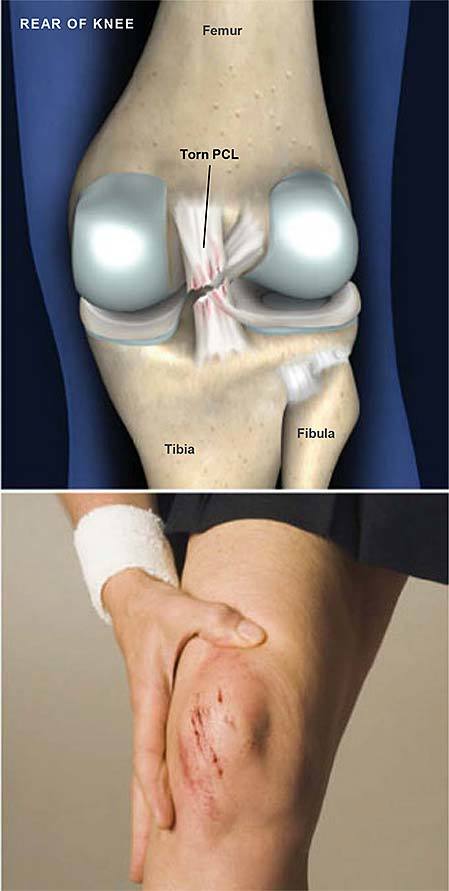 后交叉韧带损伤posterior cruciate ligament injury